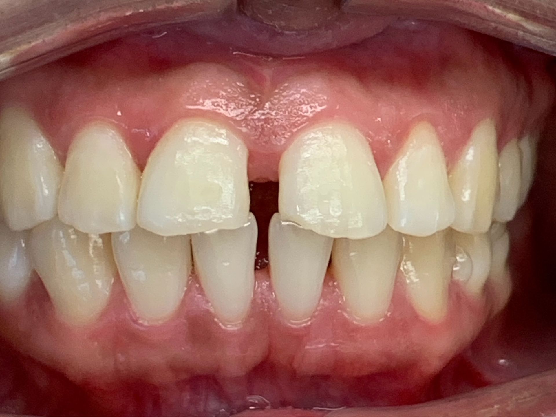 Invisalign Gap Before