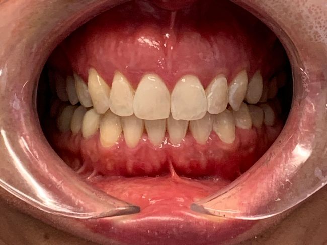 A close up of a person 's mouth with white teeth.