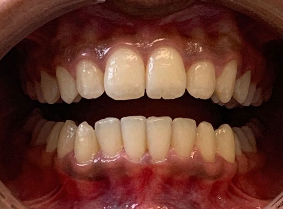 Invisalign Gap After