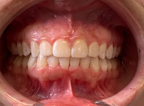 Invisalign Spacing After