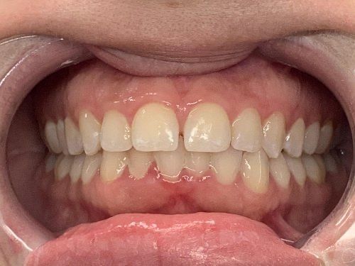 Invisalign Spacing Before