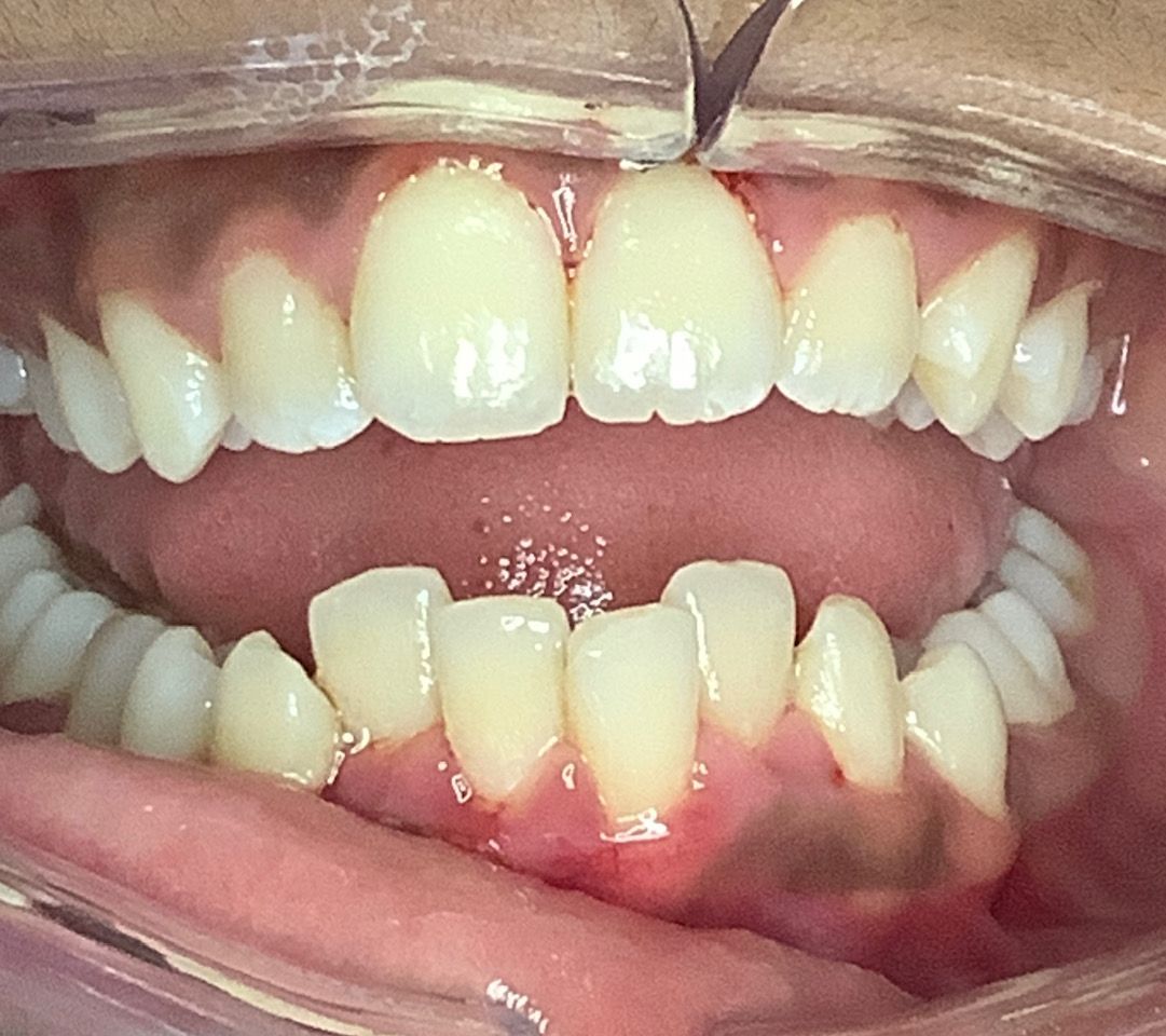 Invisalign Gap Before