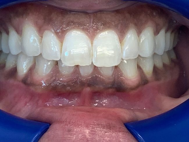 Invisalign Crowding After