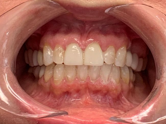 Invisalign Crowding After