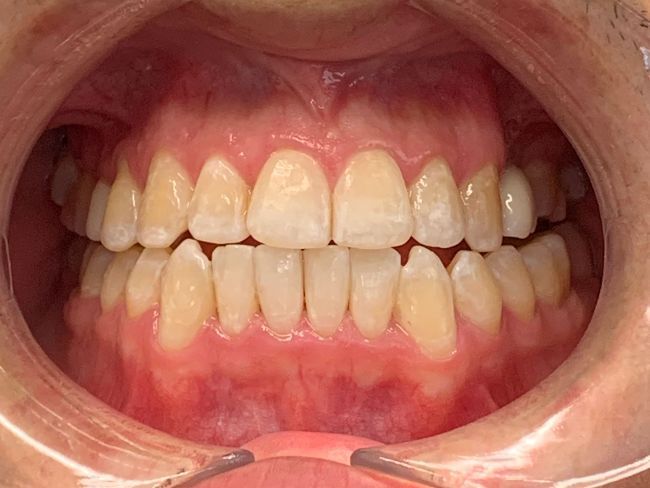 Invisalign Crowding After