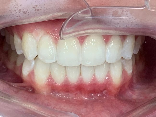 Invisalign Crowding After