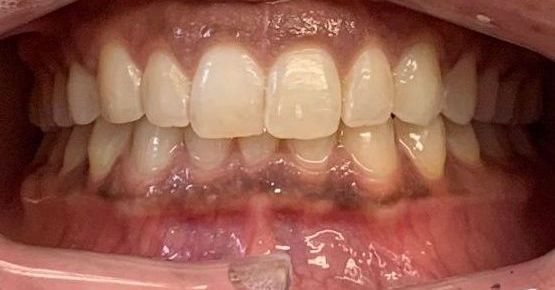 Invisalign Crowding Before