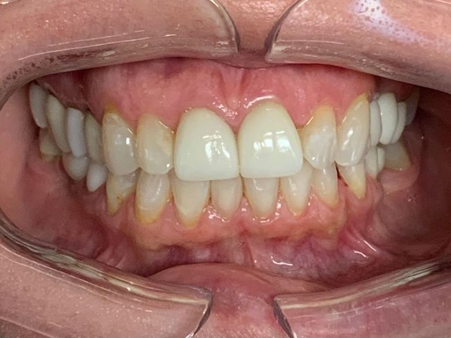 Invisalign Crowding Before