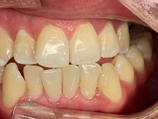 Invisalign Crowding Before