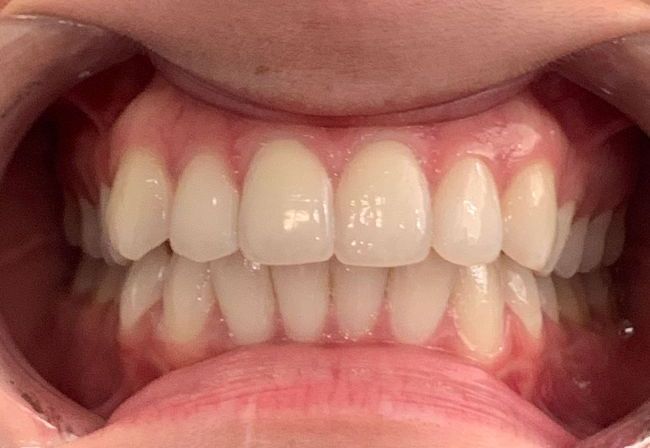 Invisalign Crowding Before