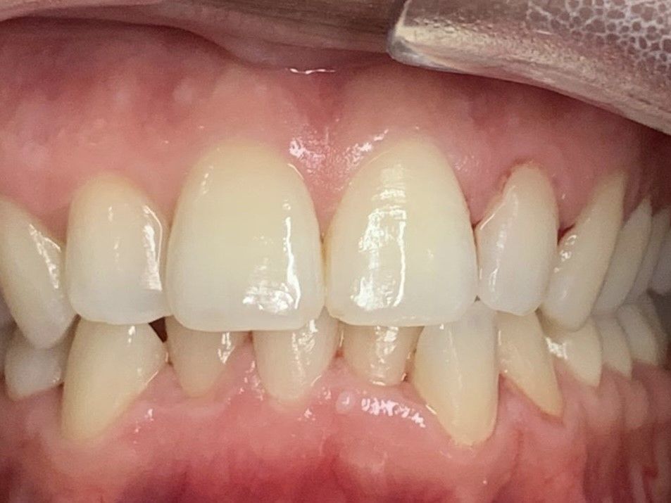 Invisalign Crowding Before