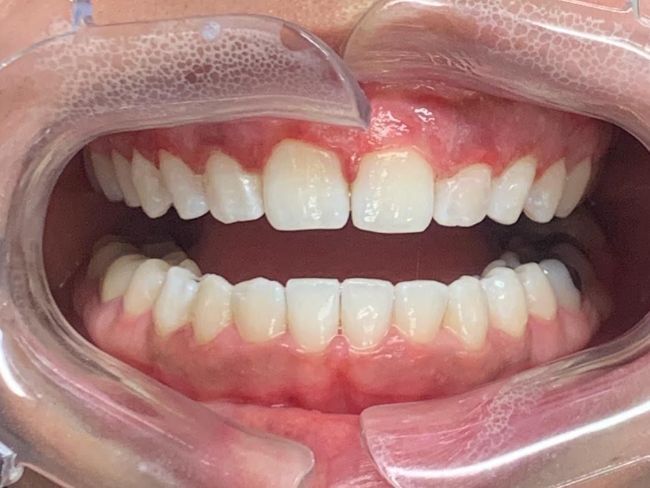 Invisalign Spacing After