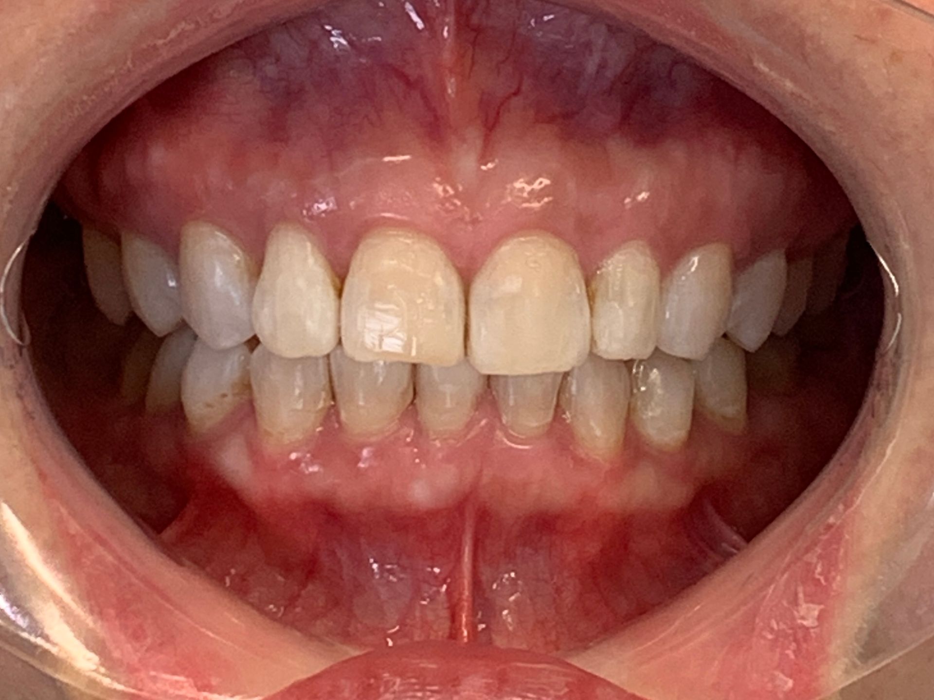 A close up of a person 's teeth in a mouth guard.