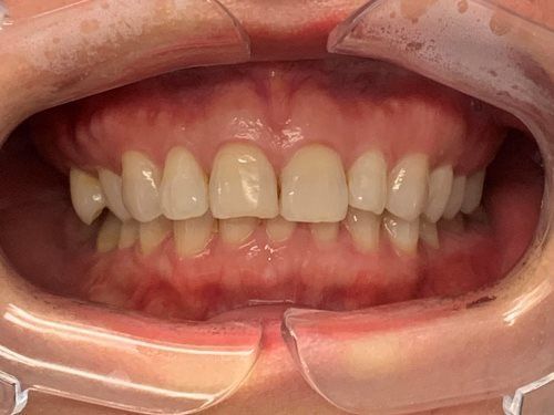 A close up of a person 's teeth in a mouth guard.