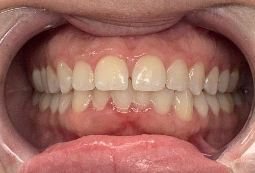 Gap Close Invisalign