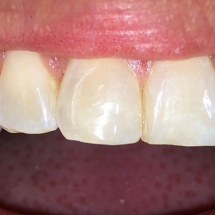 Chipped Tooth After