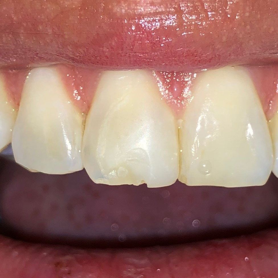 Chipped Tooth Before