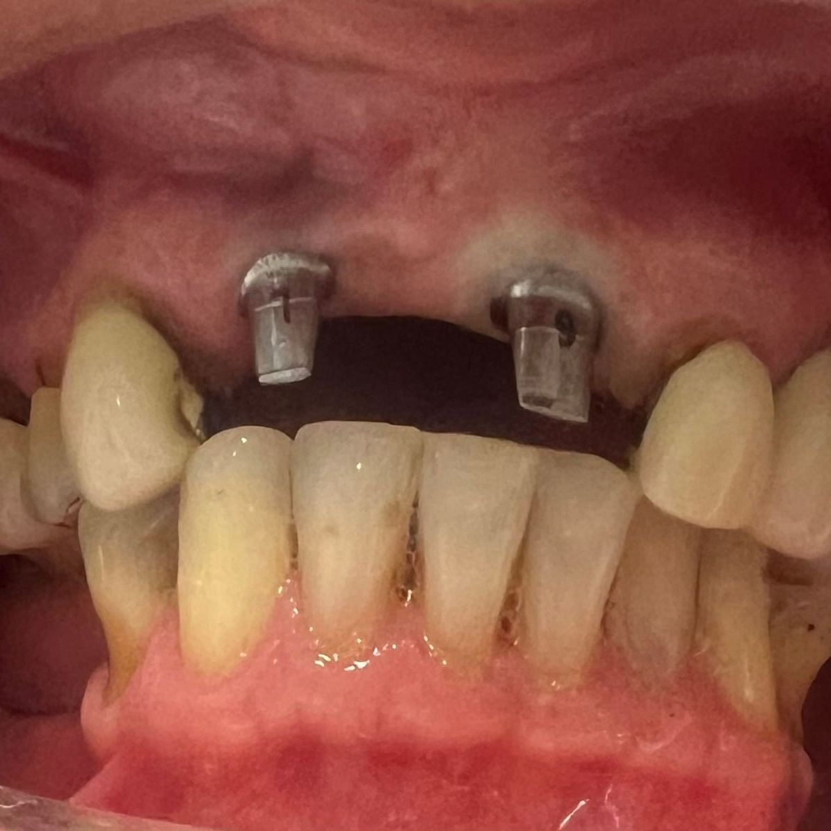 Implants and Crowns Before