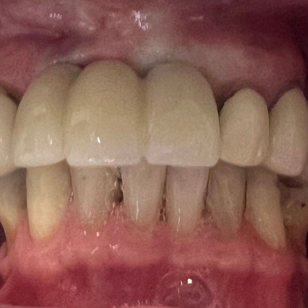 Implants and Crowns After