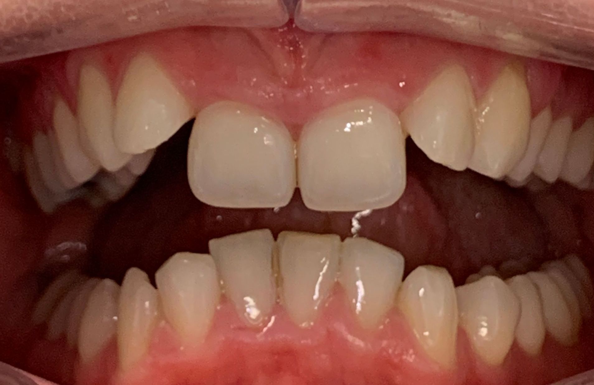 Invisalign Smile Before