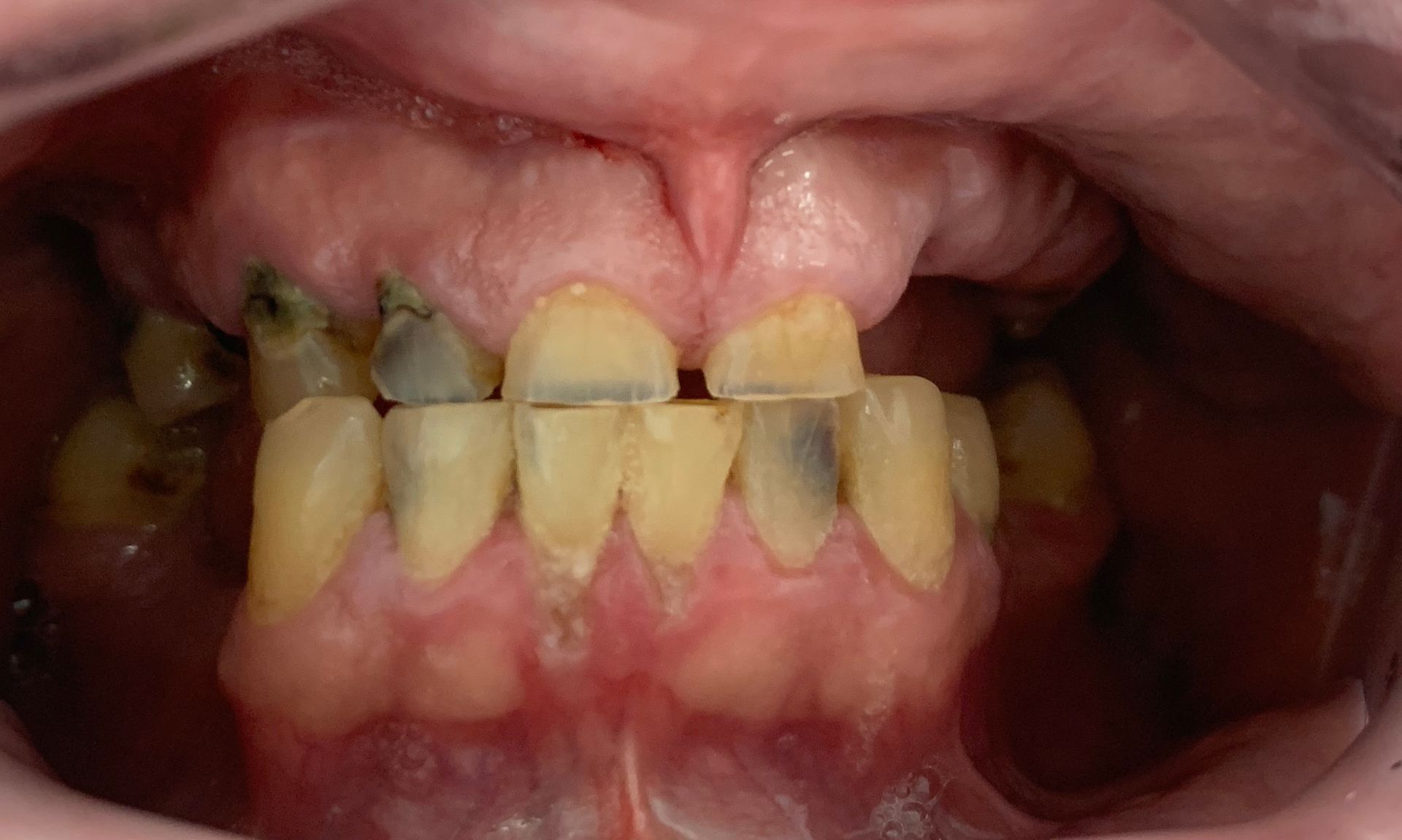 Implants and Crowns Before