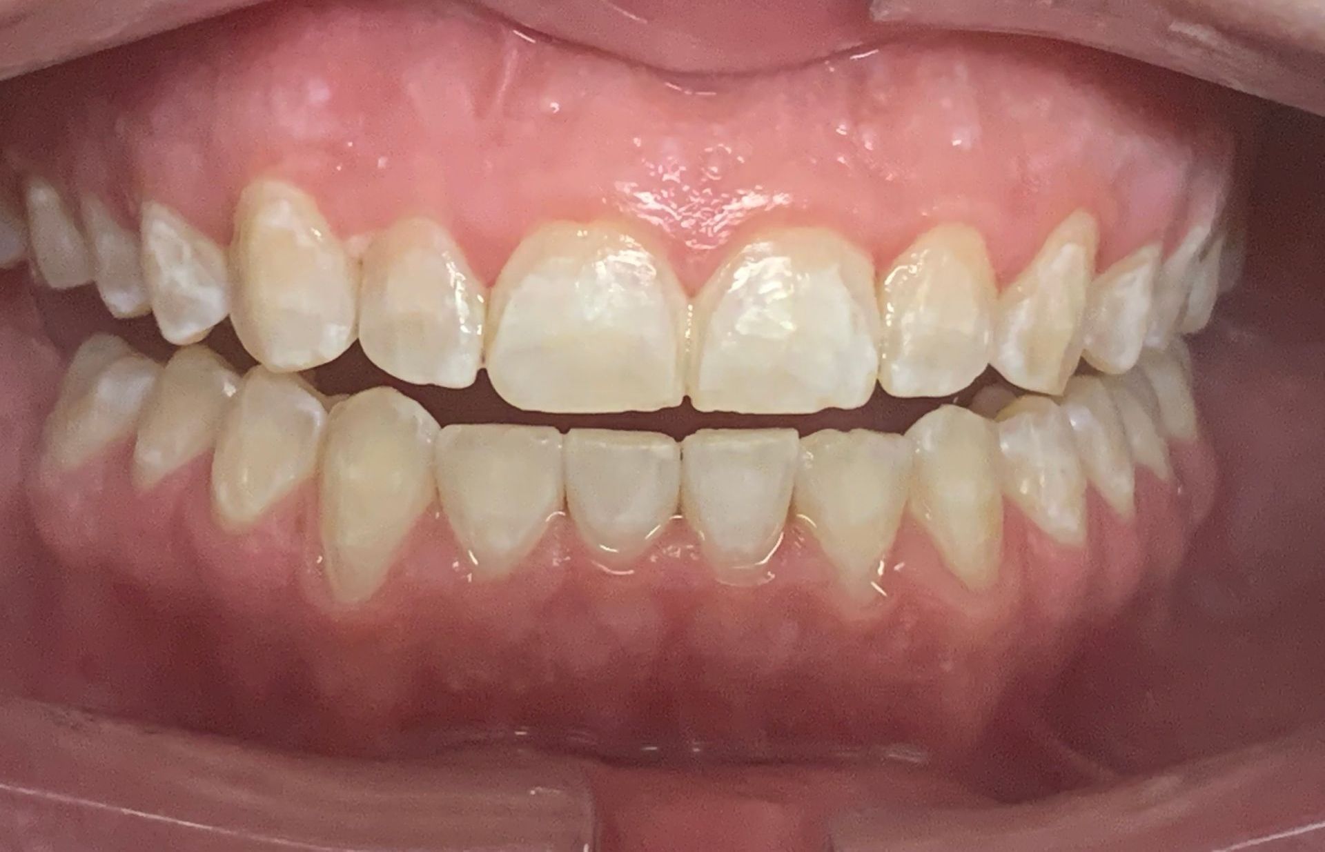 Invisalign Crowded bottom teeth After