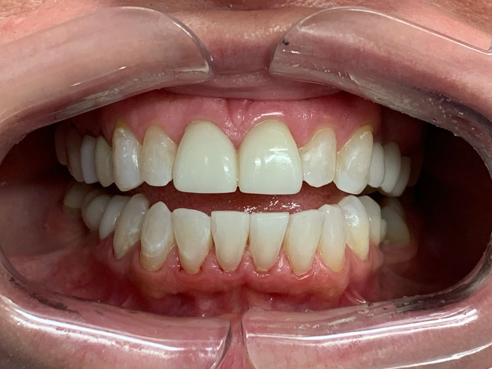Invisalign Crowding After