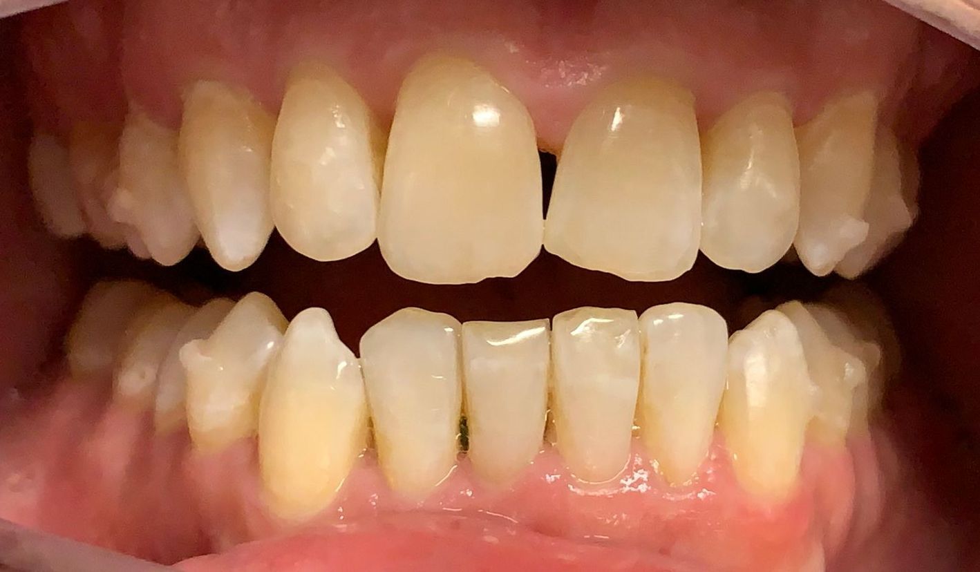 Invisalign Crowding in Lower and Spacing in Upper After