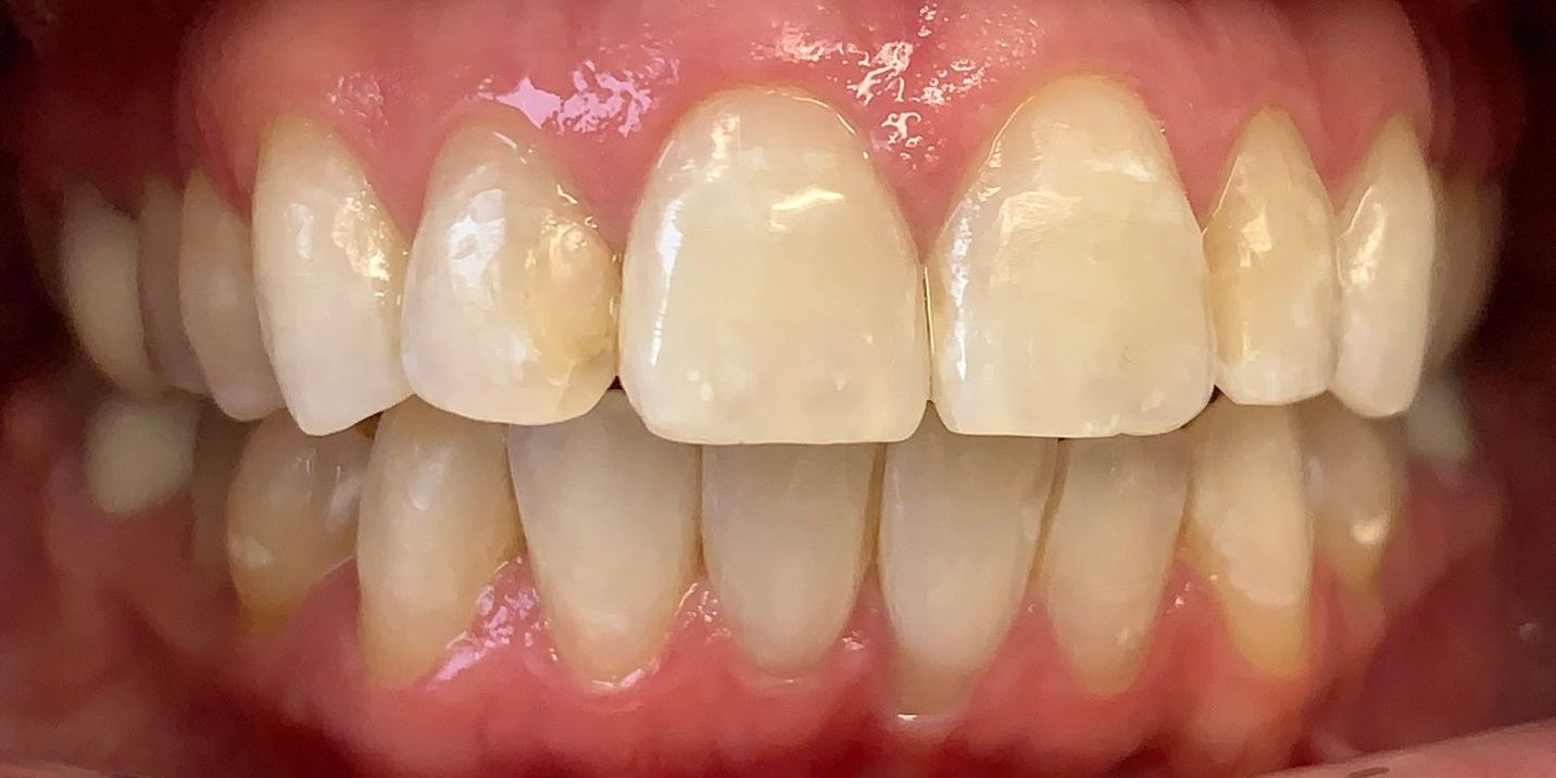 Invisalign Severe Crowding After