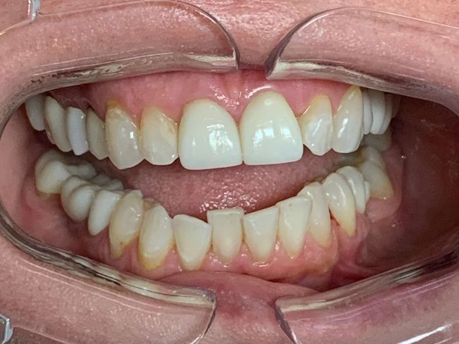 Invisalign Crowding Before