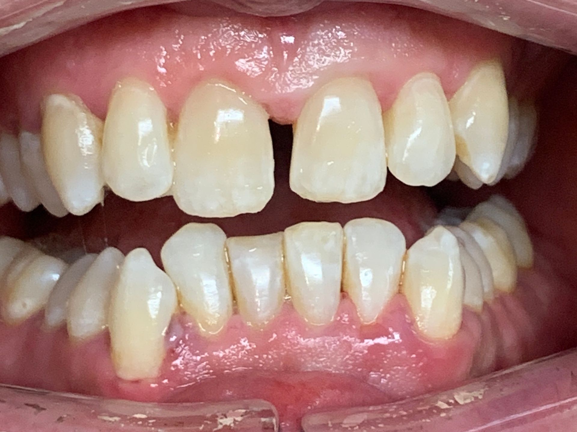 Invisalign Crowding in Lower and Spacing in Upper Before