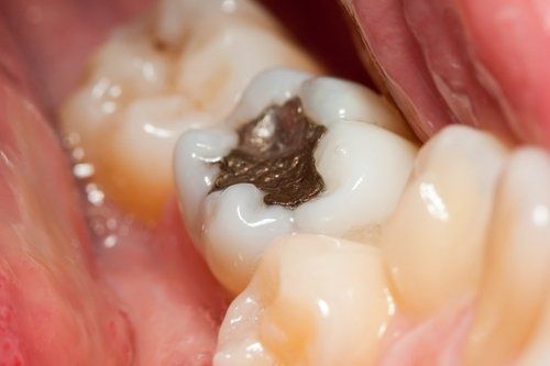 Dental Fillings Amalgam — Fort Myers, FL — Children & Adult Dentistry