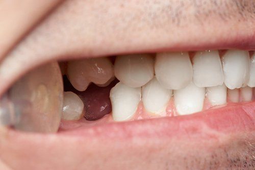 Dental Implants Missing Teeth — Fort Myers, FL — Children & Adult Dentistry