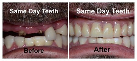 Before and After Same Day Teeth — Fort Myers, FL — Children & Adult Dentistry