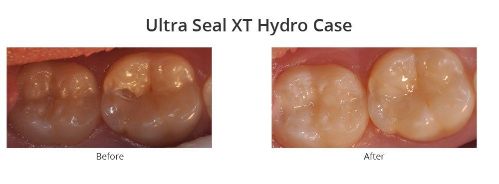 Before and After Ultra Seal XT Hydro Case — Fort Myers, FL — Children & Adult Dentistry