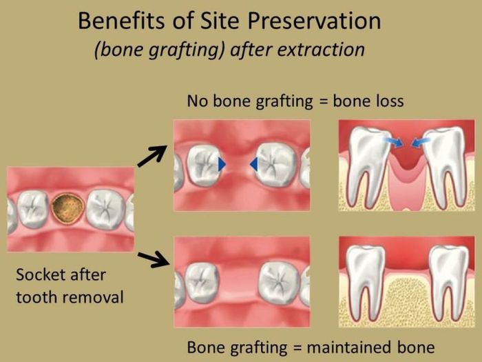 Bone Grafting — Fort Myers, FL — Children & Adult Dentistry