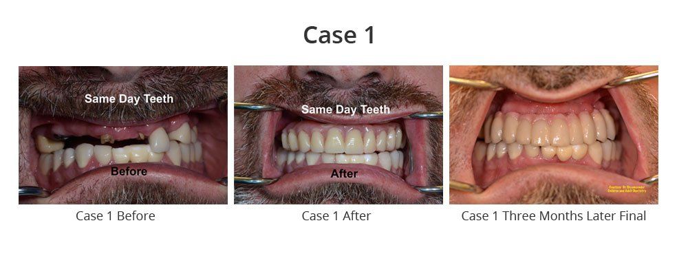 Before and After Adding Dentures — Fort Myers, FL — Children & Adult Dentistry