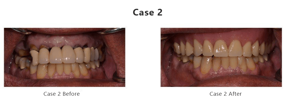 Teeth Before and After — Fort Myers, FL — Children & Adult Dentistry