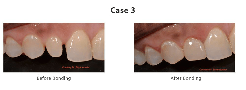 Before and After Bonding — Fort Myers, FL — Children & Adult Dentistry