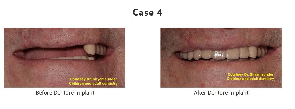 Before and After Denture Implant — Fort Myers, FL — Children & Adult Dentistry