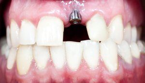 Implant Restoration — Fort Myers, FL — Children & Adult Dentistry