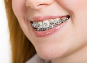 Girl with Clear Braces — Fort Myers, FL — Children & Adult Dentistry