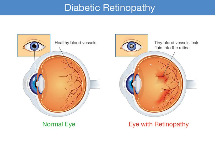 Diabetic Retinopathy | Ross Eye Institute 
