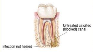 rootcanal re-treatment 1