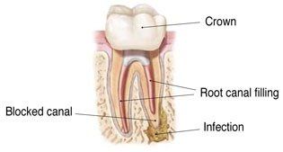rootcanal re-treatment 2