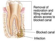 rootcanal re-treatment 3