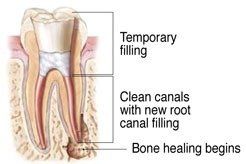 rootcanal re-treatment4