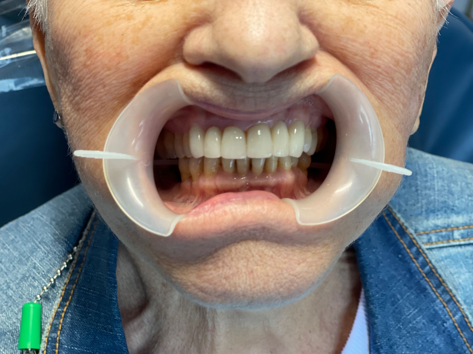A close up of a person 's mouth with a mouth guard on it.