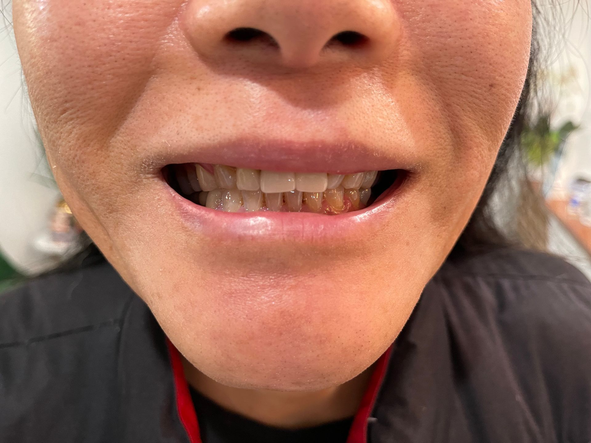 A close up of a woman 's mouth with her teeth showing.