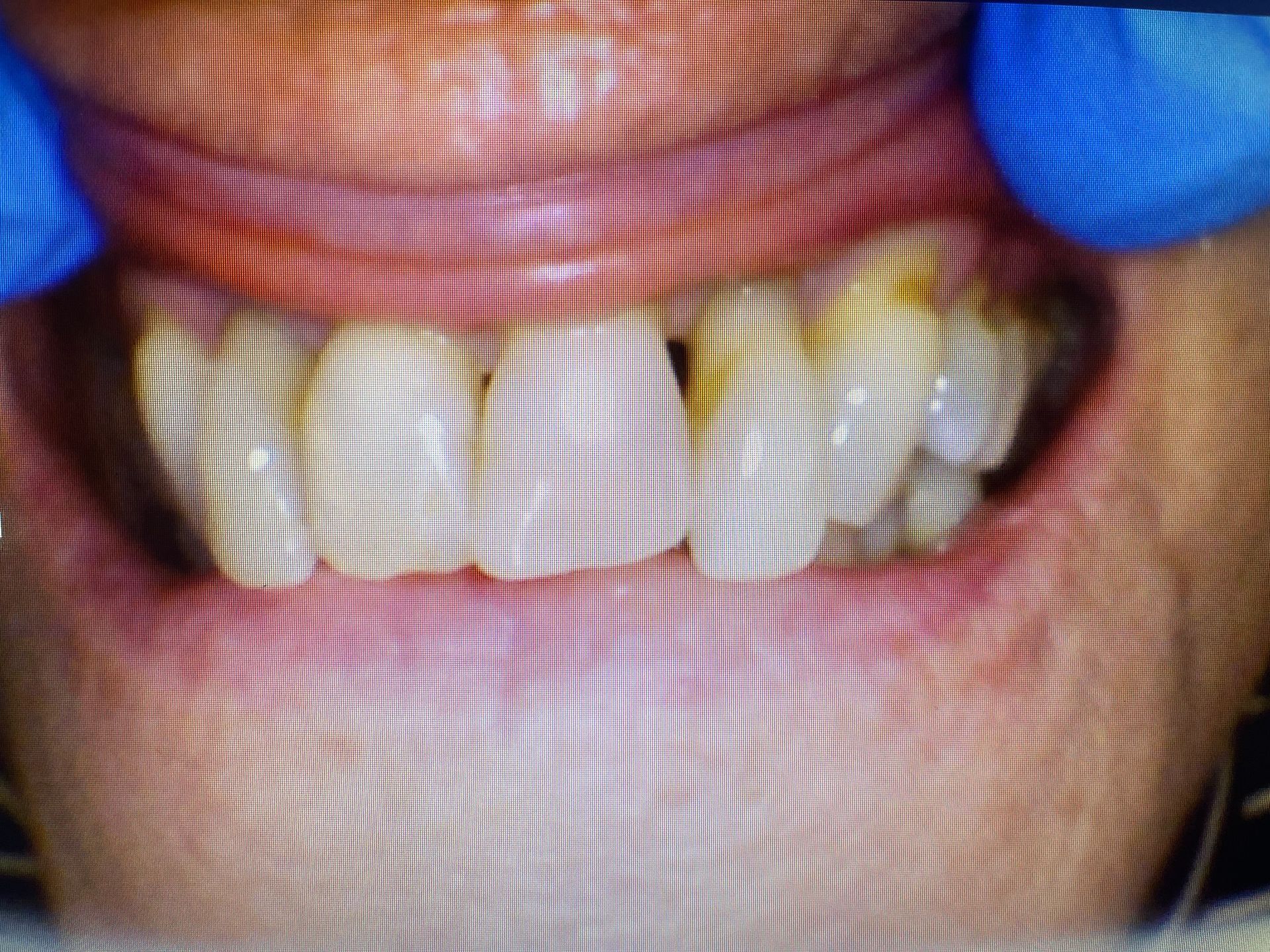 A close up of a person 's teeth with a blue glove on.